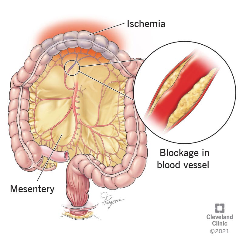 mesenteric ischemia