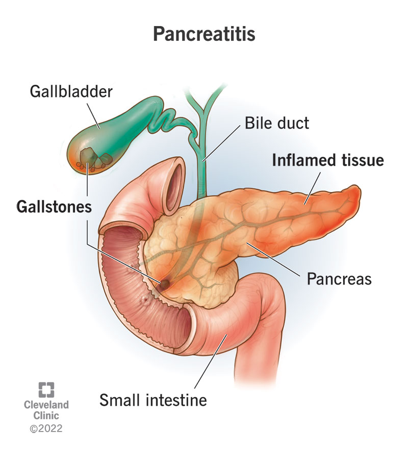 Pancreatitis