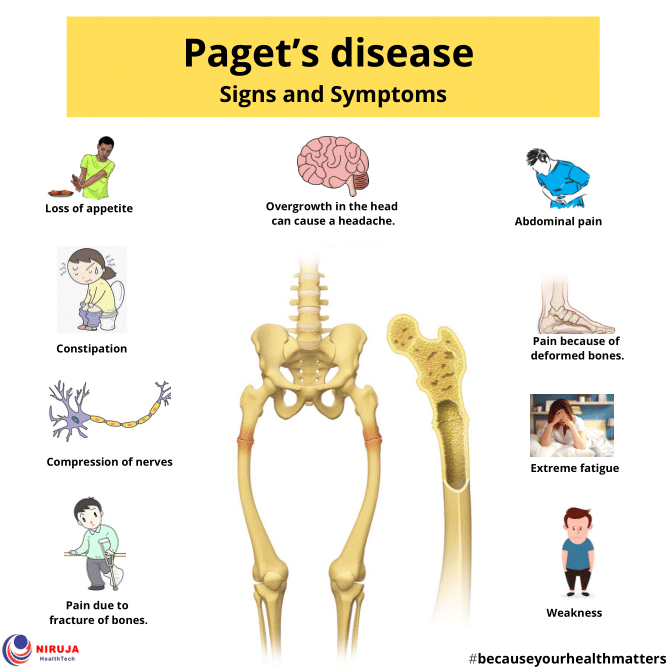 Paget’s disease Signs and Symptoms